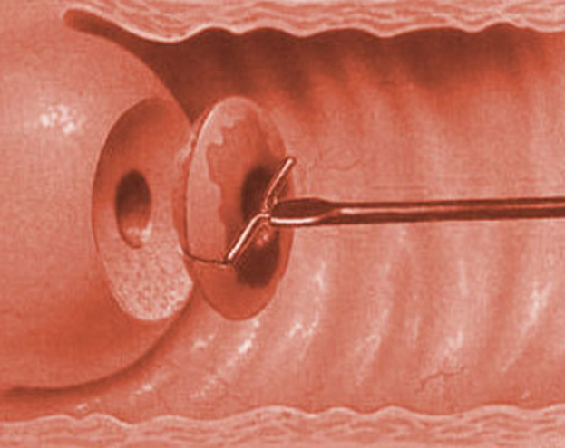 Penetrate cer cervix