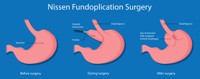 What Is A Hiatal Hernia Symptoms Causes Diagnosis Treatment And