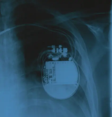 Cardiac Resynchronisation Therapy CRT