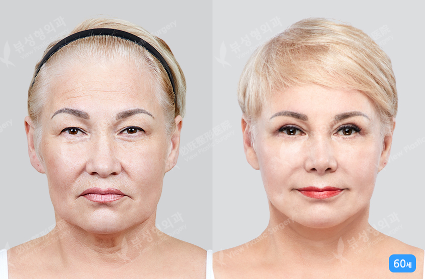 Benefícios da cirurgia de lifting facial