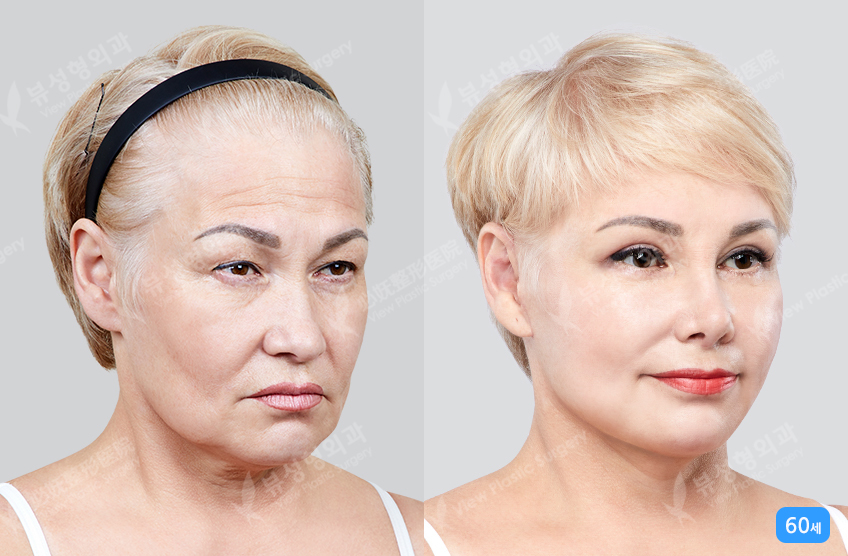 Benefits of facelift surgery