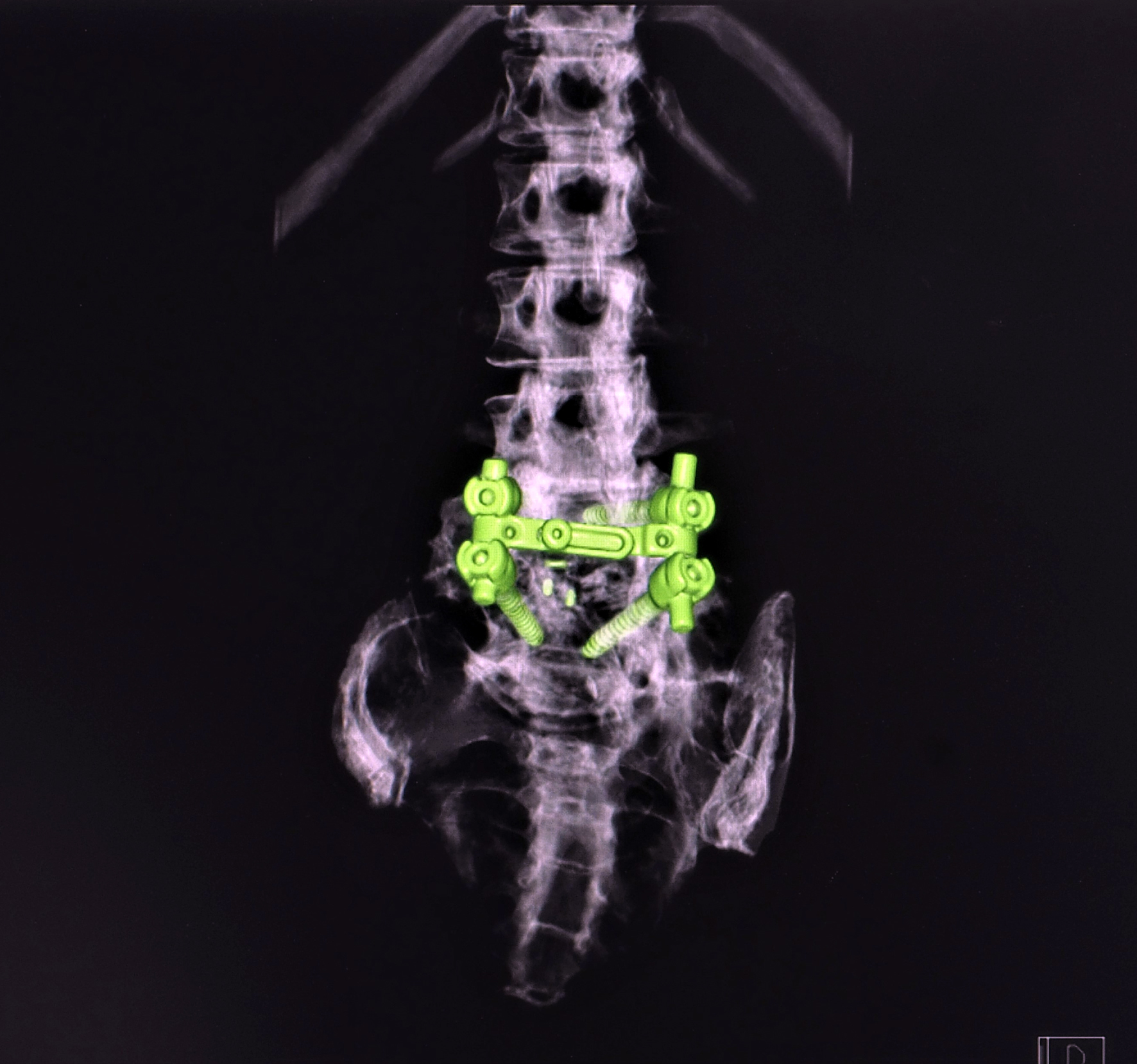 Anterior Lumbar Interbody Fusion (ALIF)