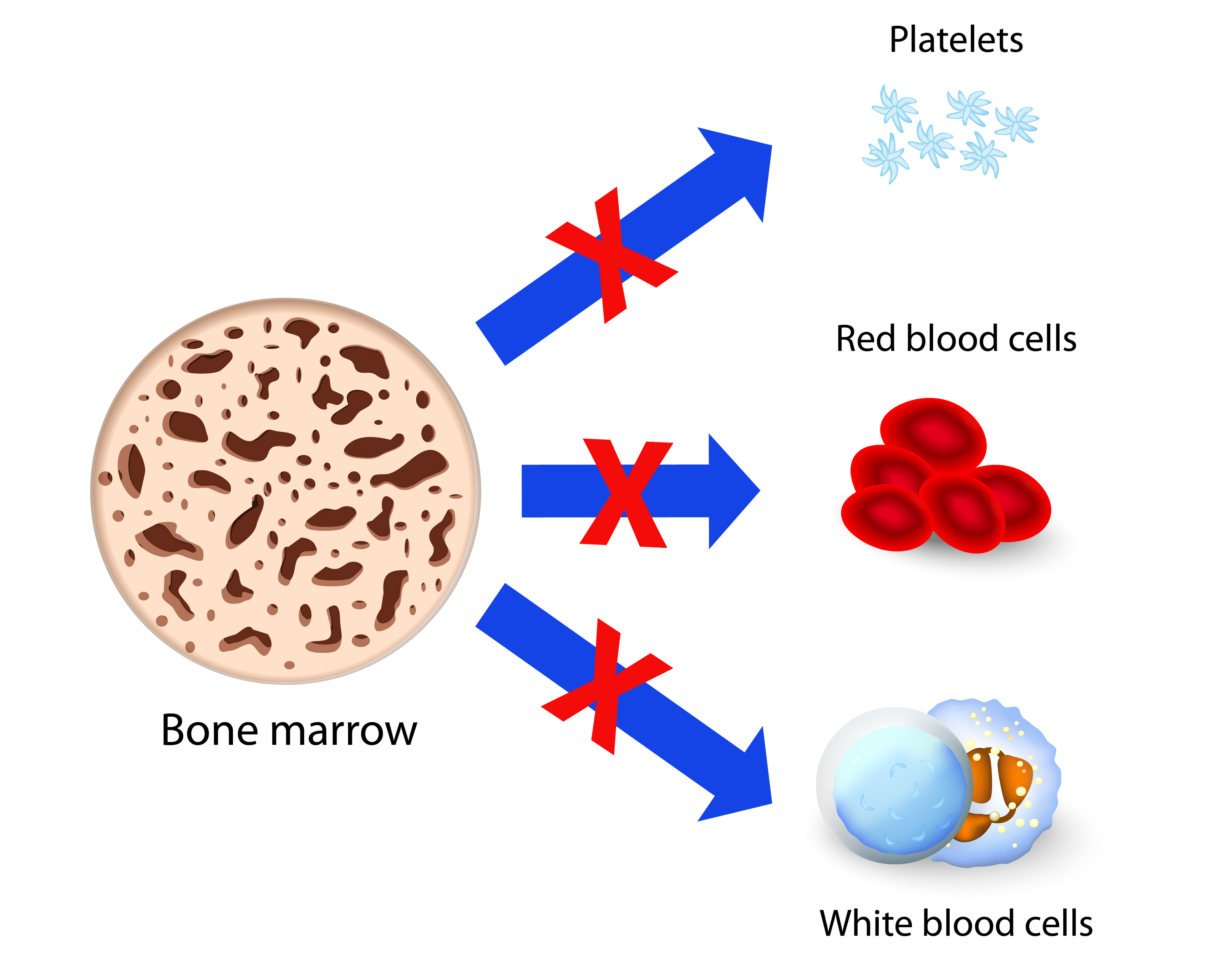 aplastic-anemia