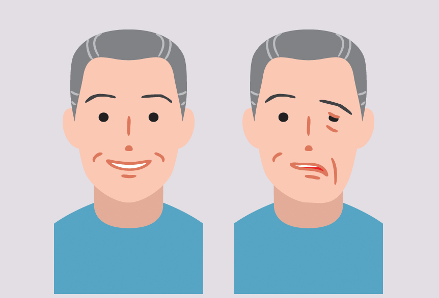 What is Bell’s palsy?