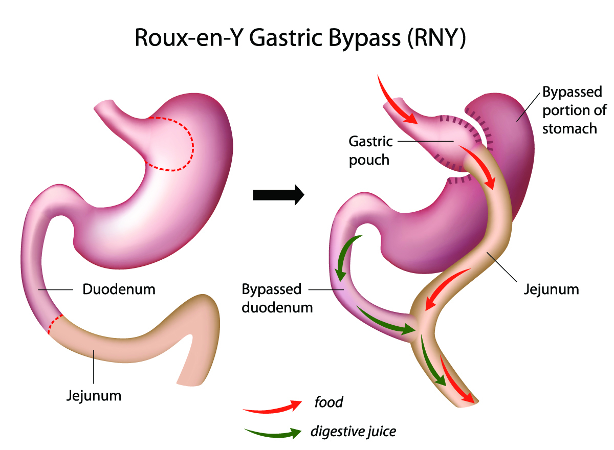 Specialties Gastric Bypass Surgery