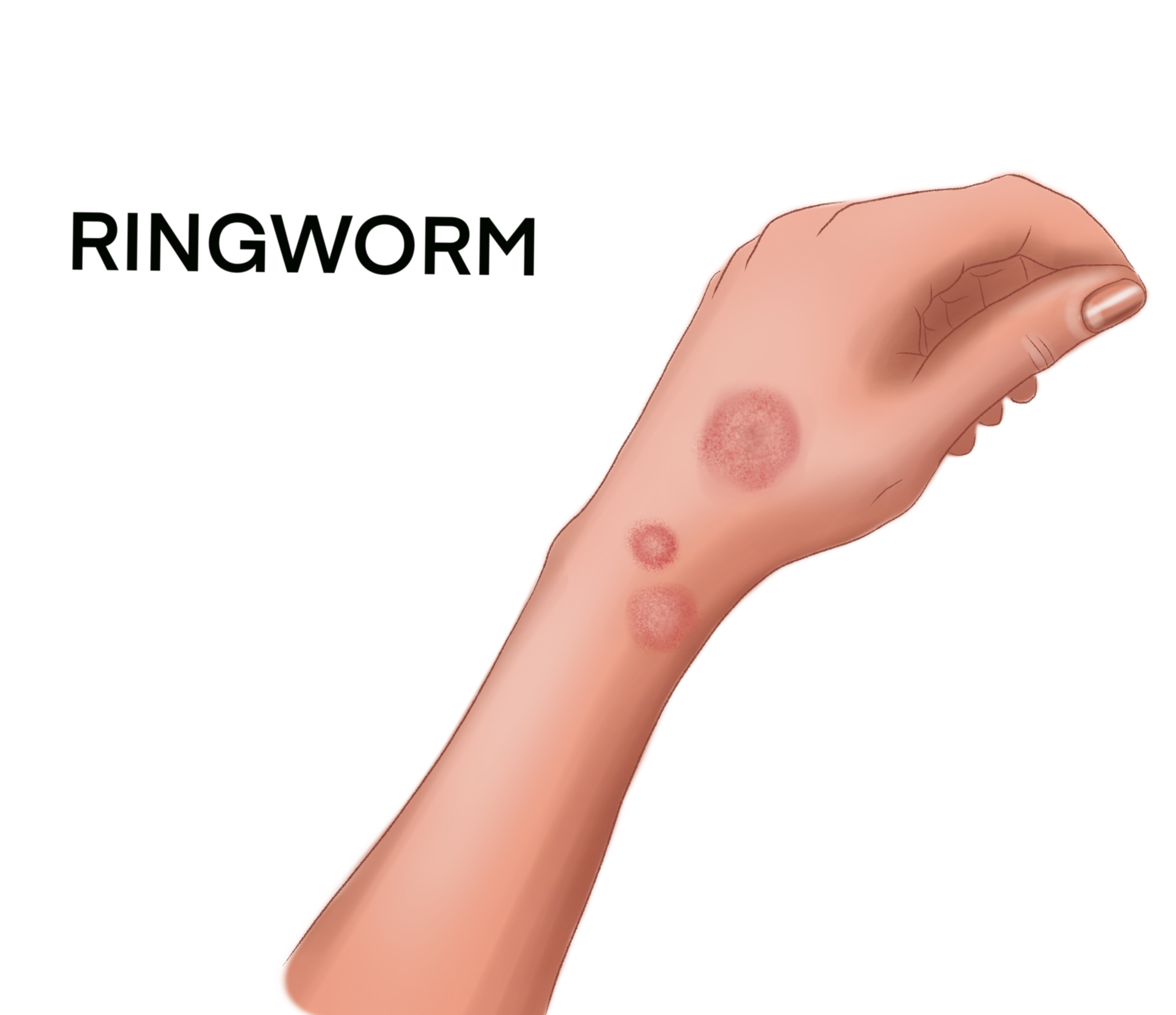 1-Ringworm-c2593c0b-5814-4304-b09e-d2d3931f99a0.jpg