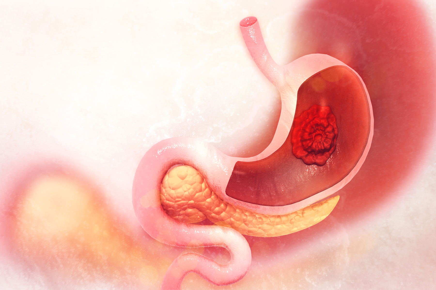 What is stomach cancer?
