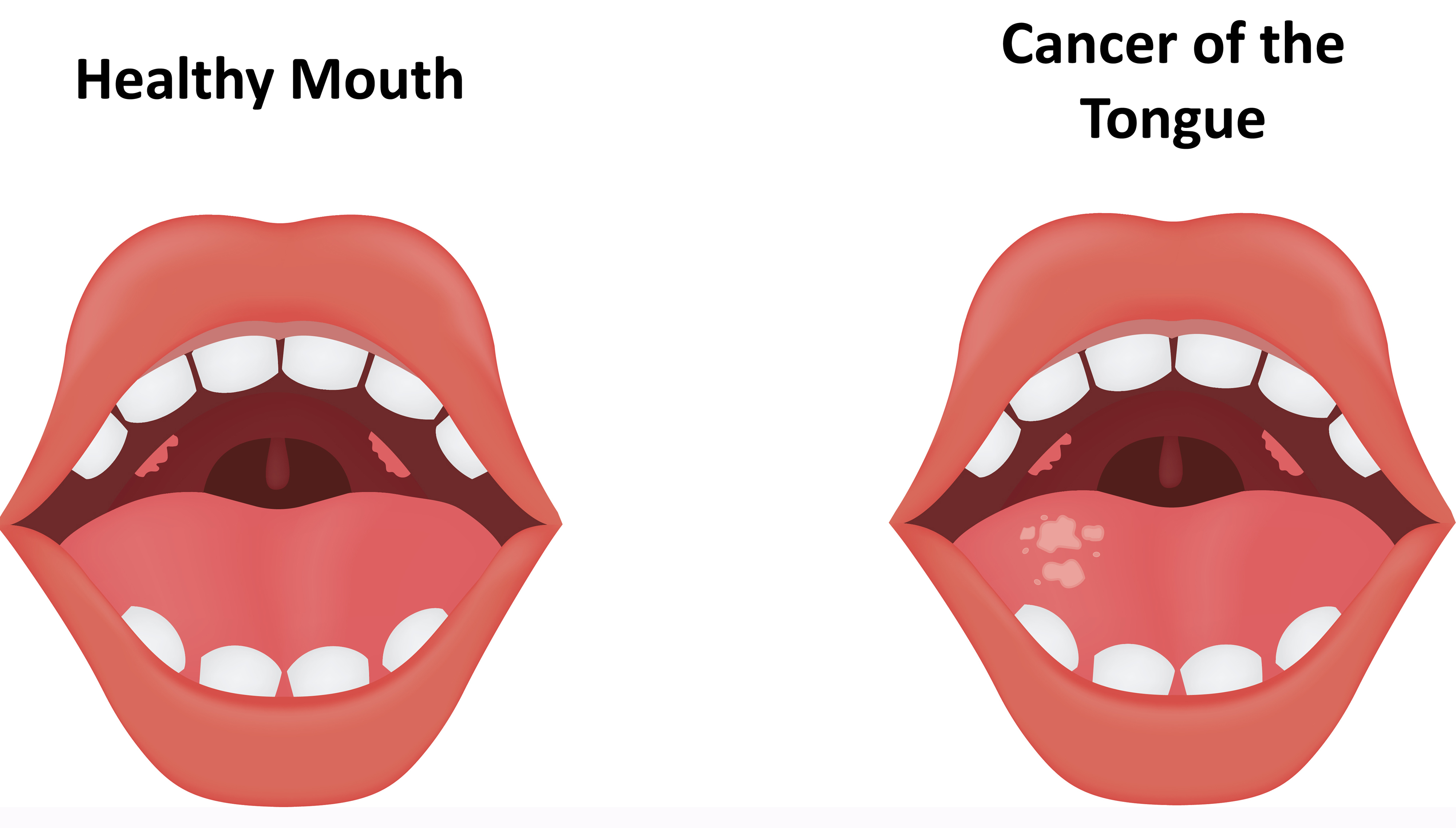 Tongue Cancer