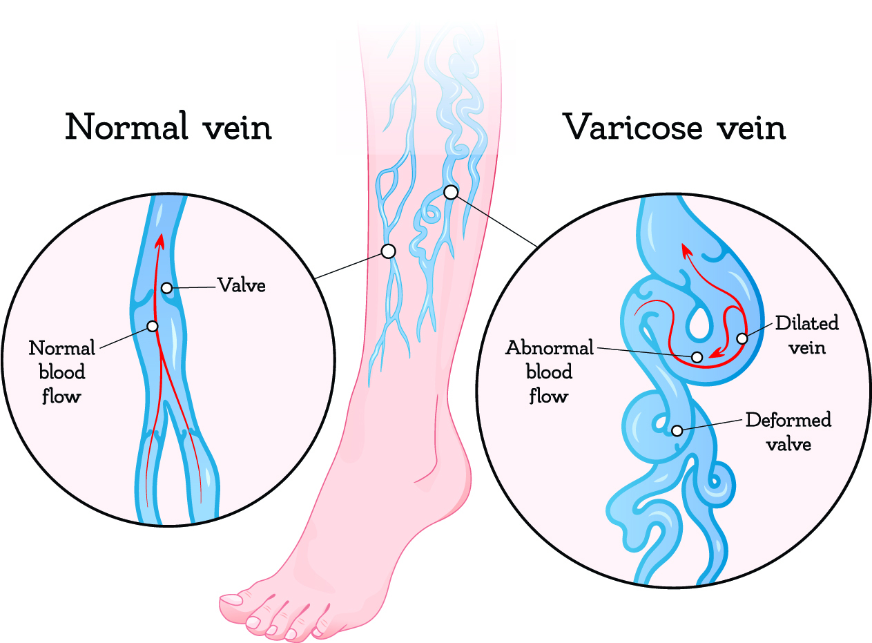 Varicose veins