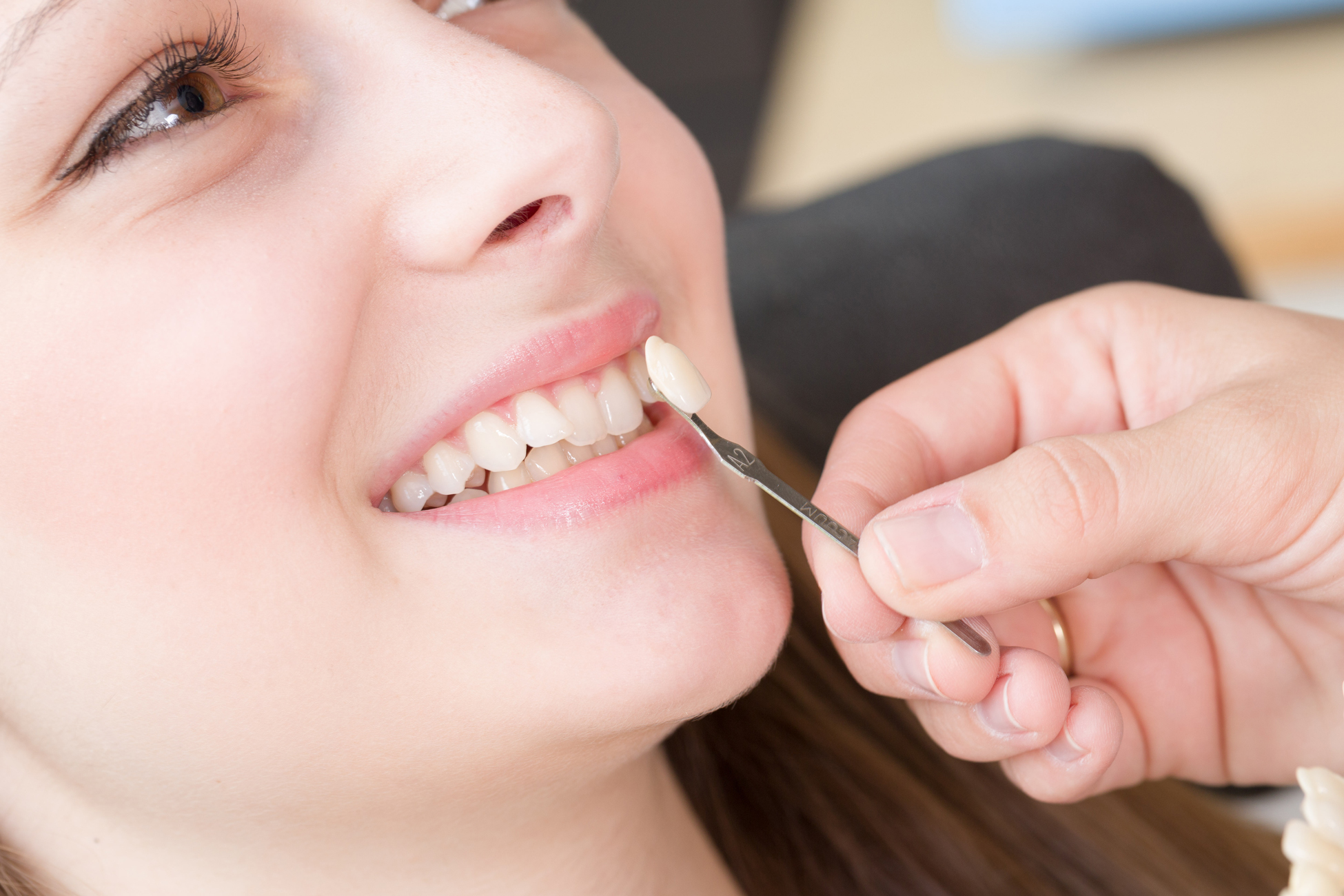 Everything you need to know about Veneers Definition, cost