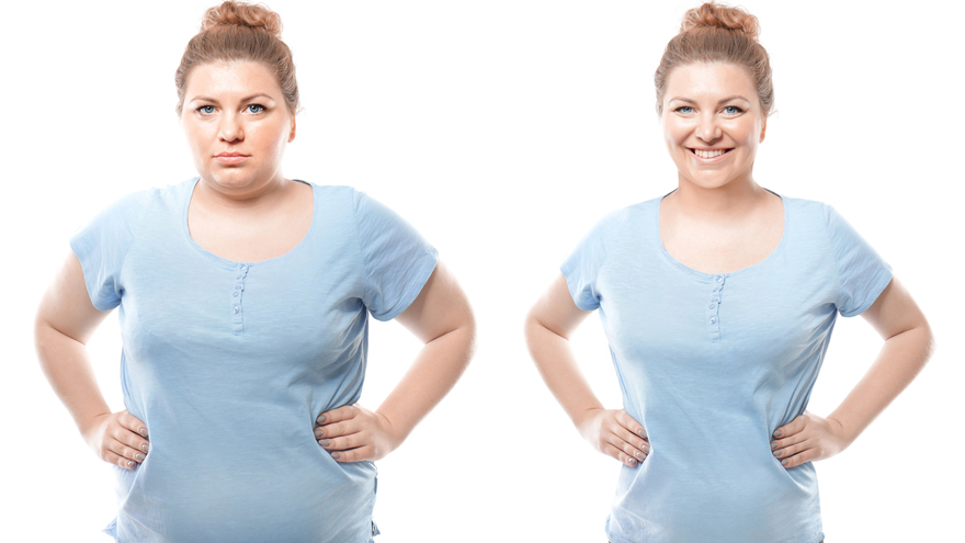 before & after gastric balloon 