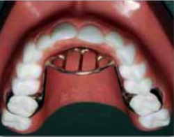 11-Removable-orthodontic-appliance-ed488335-1a60-4c57-b5e3-171e5eafcab8.jpg