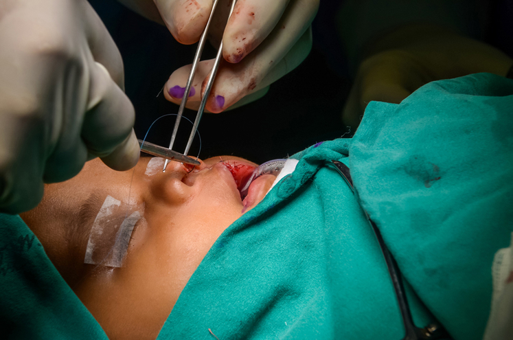 Congenital craniofacial anomalies surgery