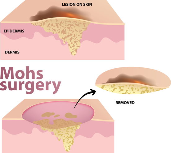 Mohs micrographic surgery