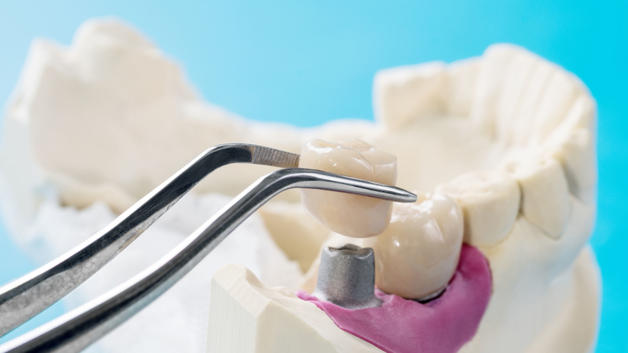 Implant dentistry