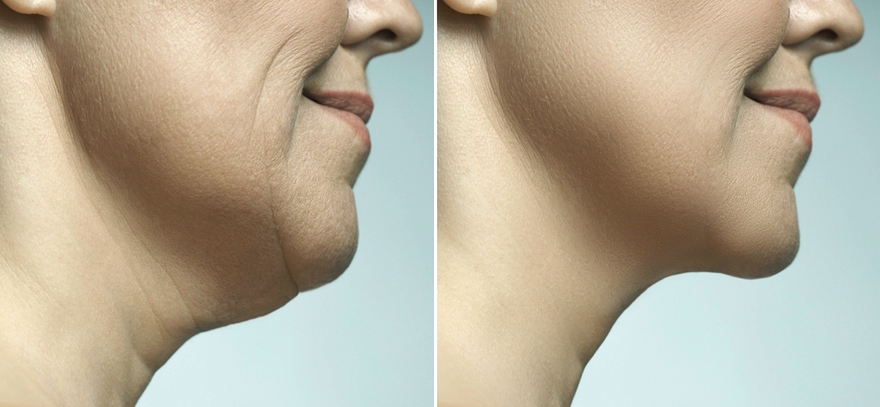 What Is Facial Liposuction