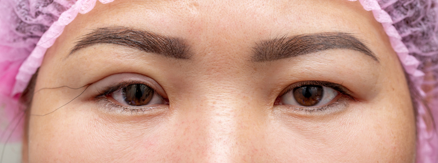 upper and lower eyelids