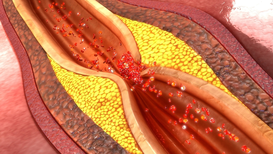 Coronary Artery Pathophysiology