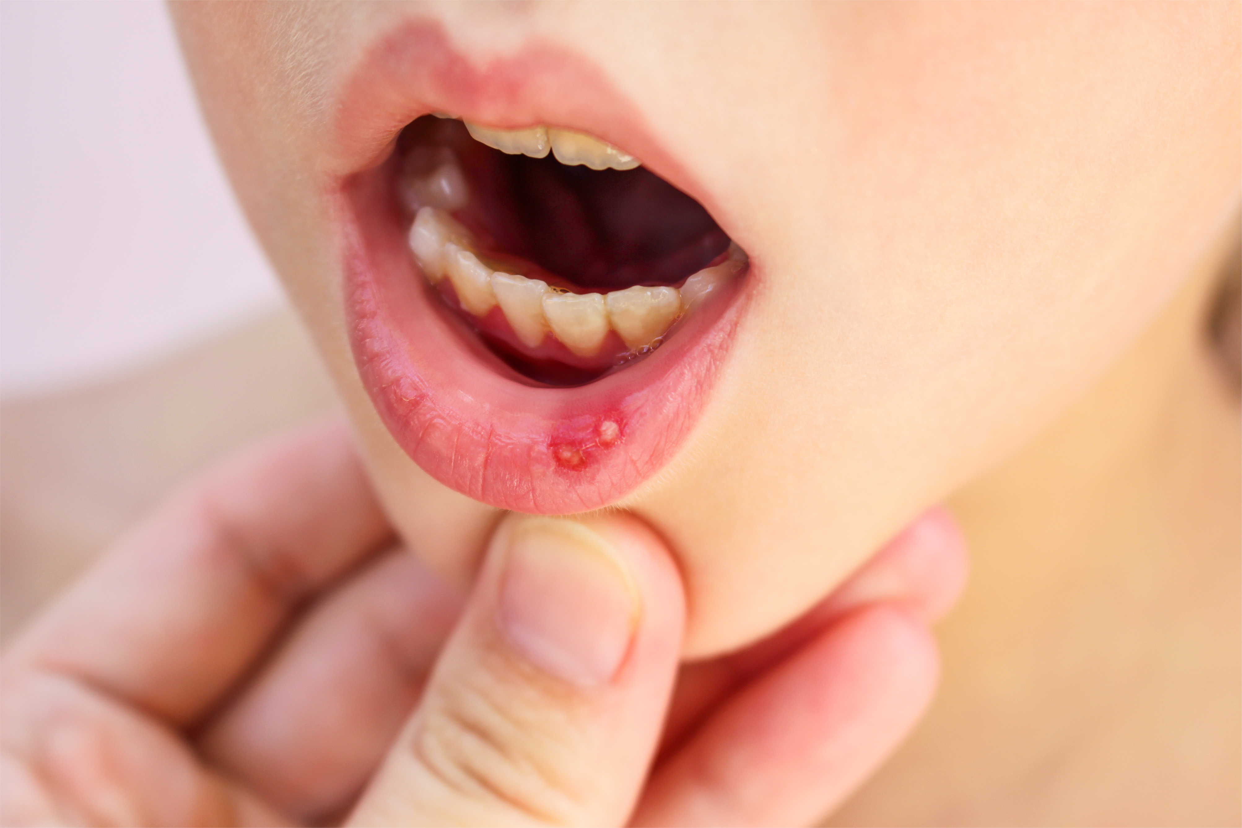 Canker Sore on Tongue
