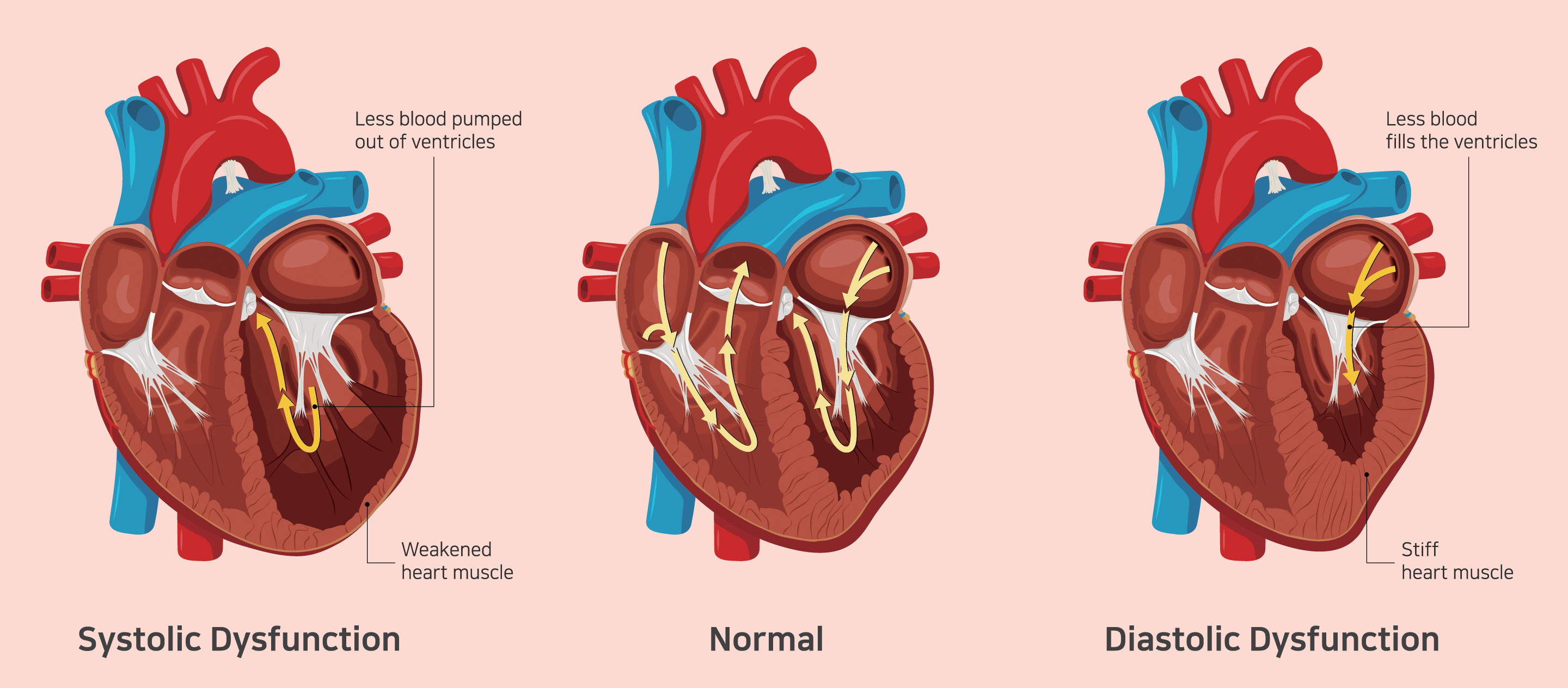 congestive-heart-failure-causes-symptoms-and-treatments