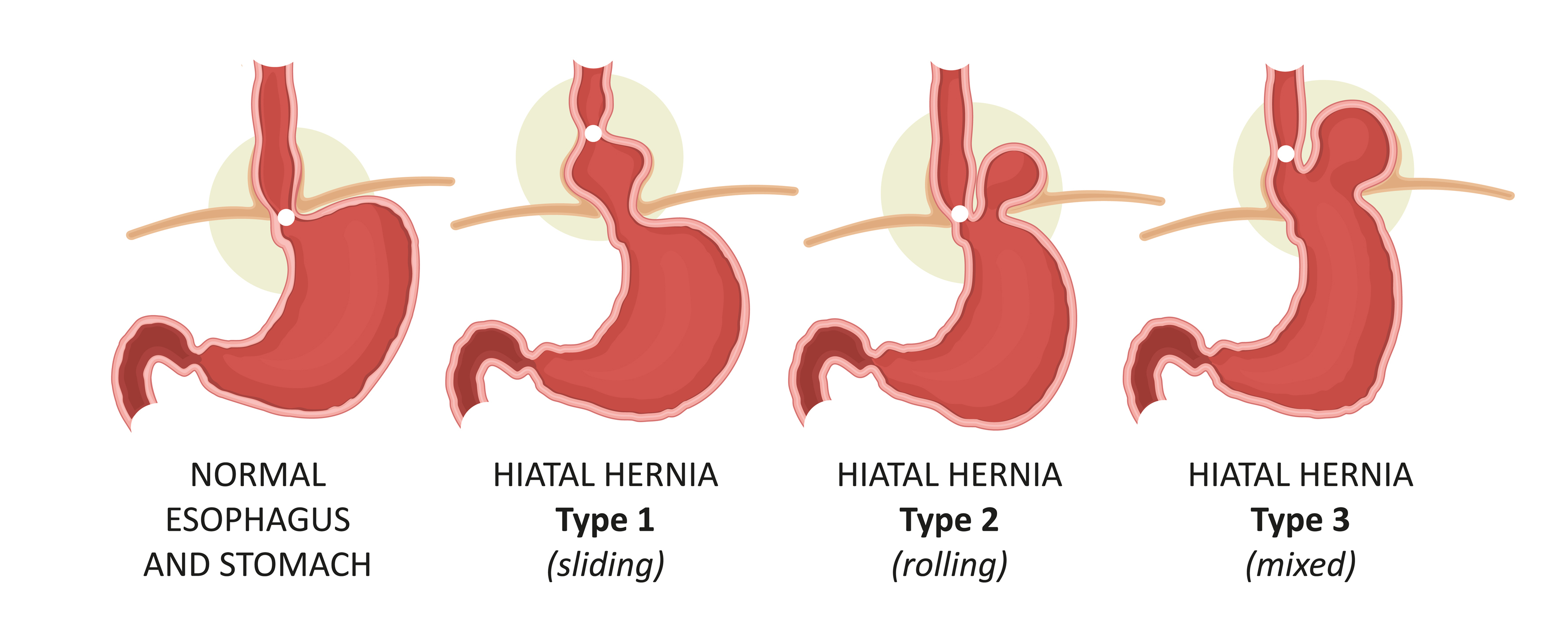 Hiatal hernia types