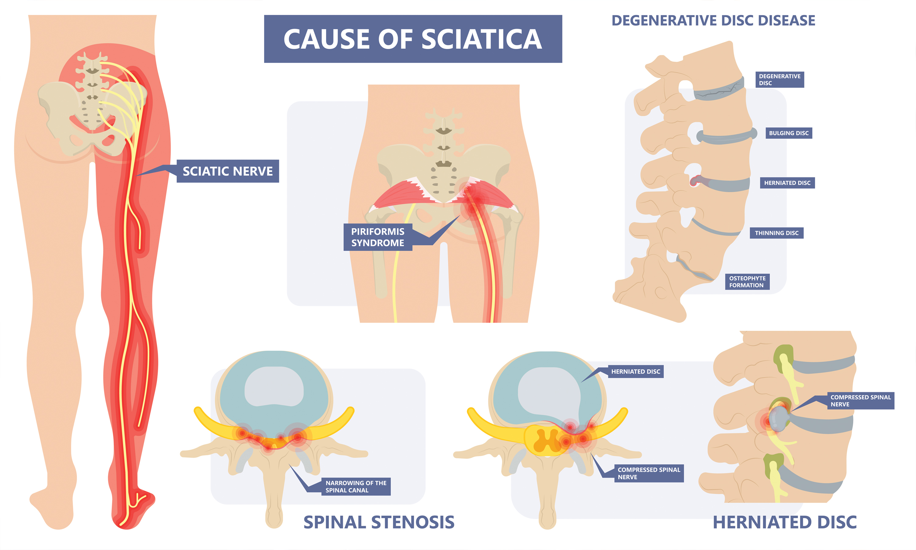 what causes sciatica? 