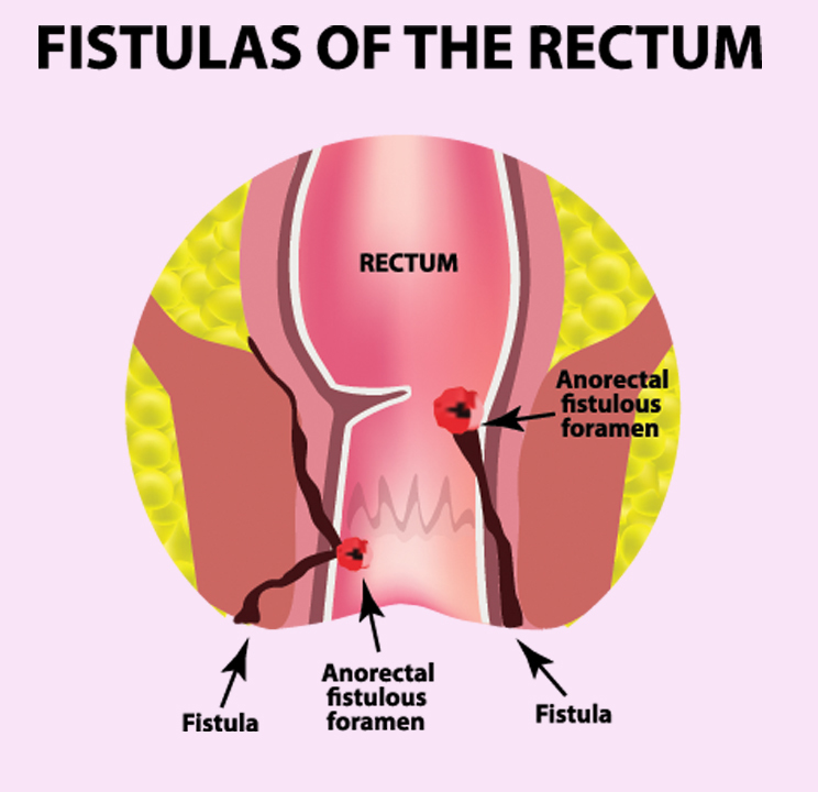 All you need to know about Anal Fissures - CloudHospital