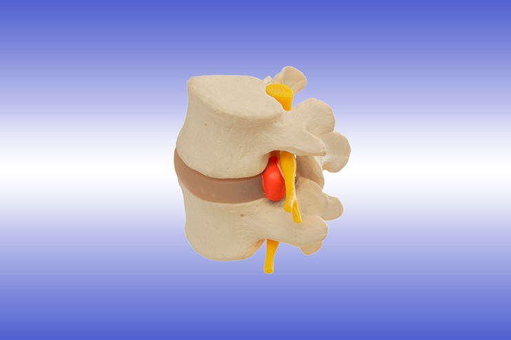 Cervical Herniated Nucleus Causes
