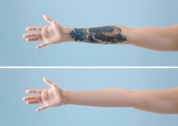 Tattoo Removal In DubaiKnow The Best ClinicsDoctorsCosts  More