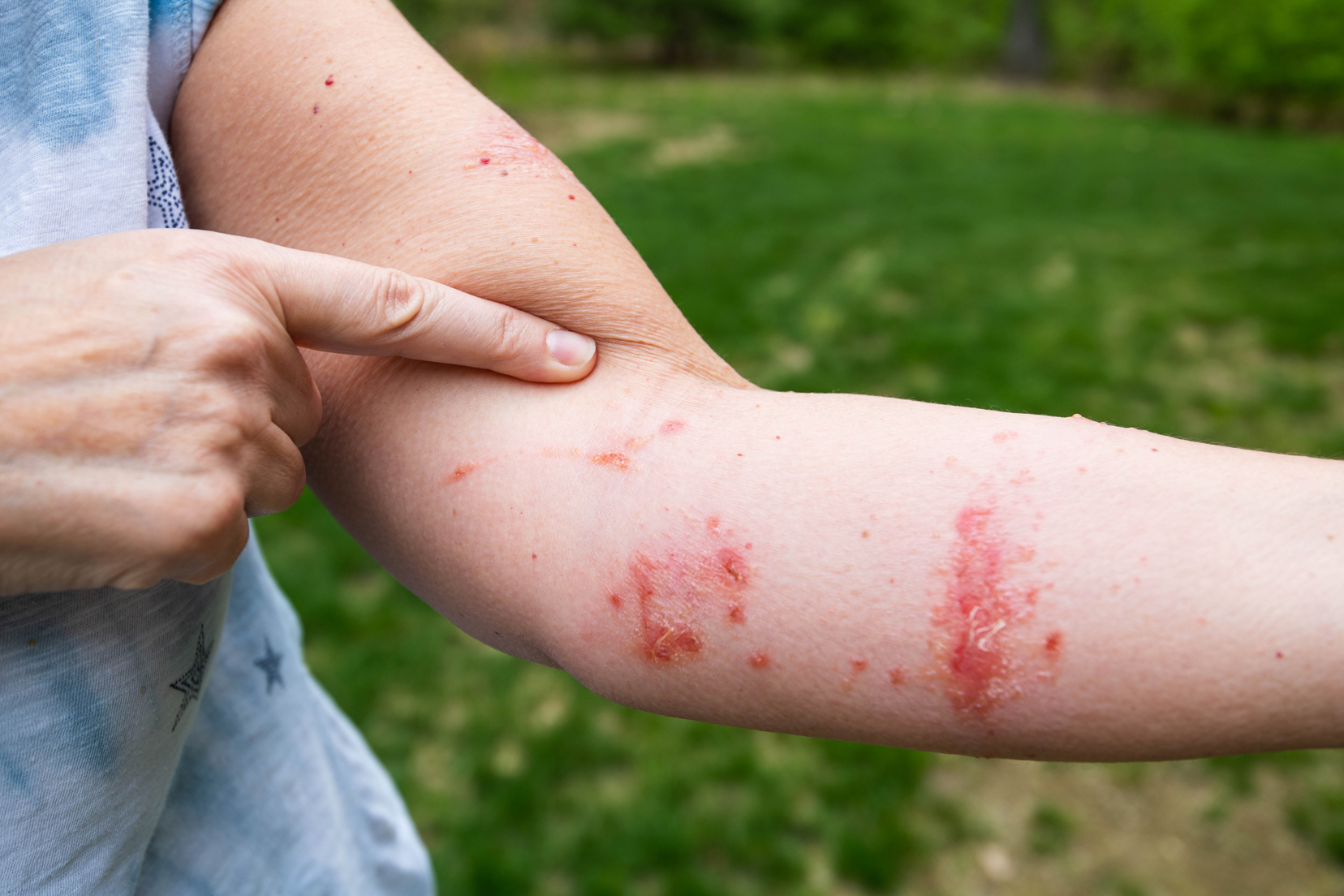 What causes the allergic reaction?
