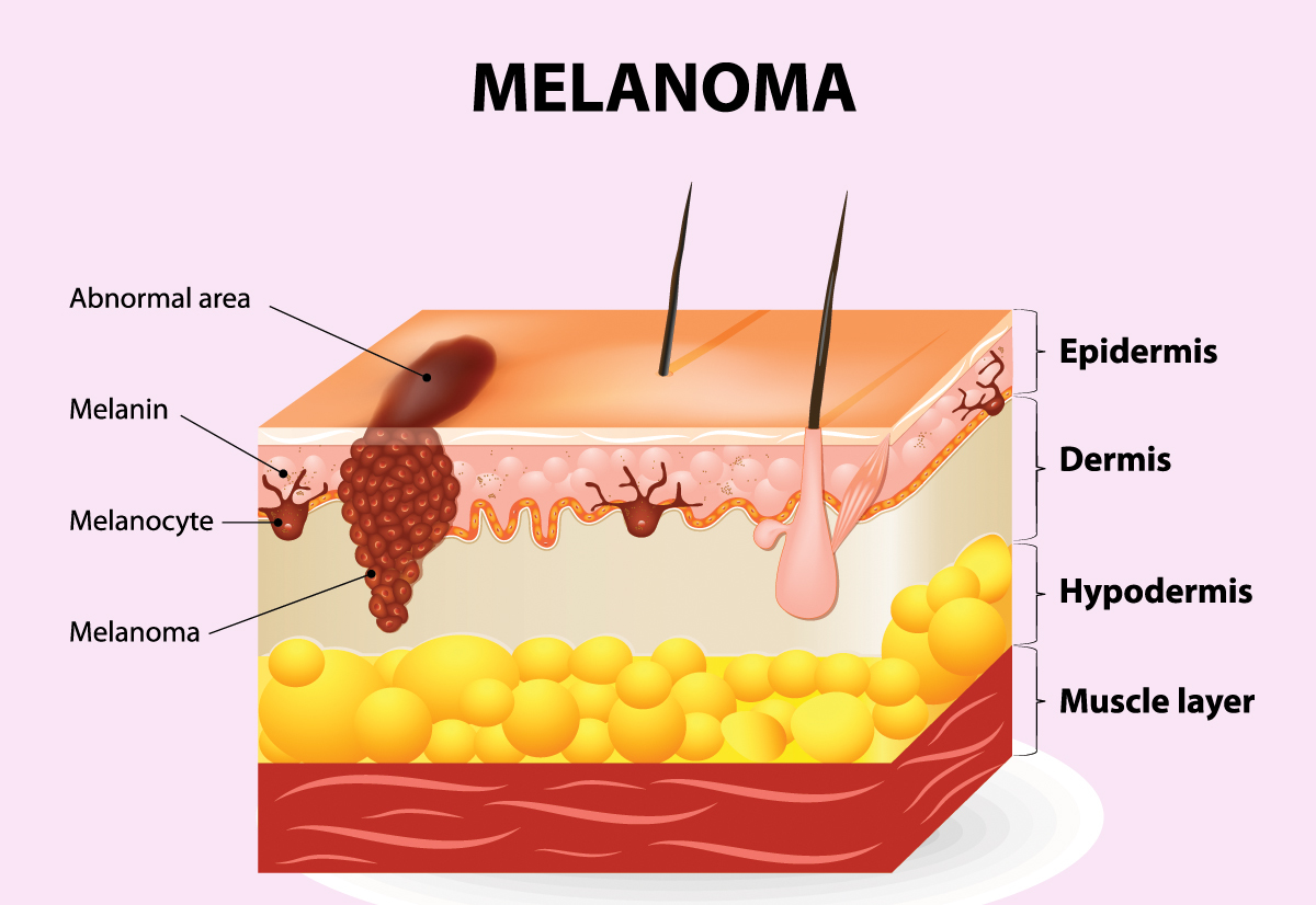 skin-cancer-treatment-choosing-a-skin-cancer-expert