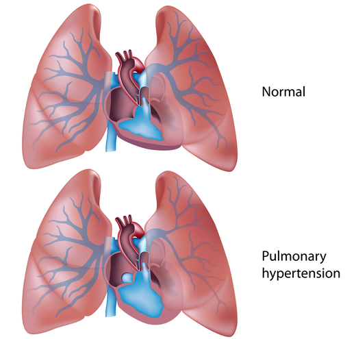 Etiology of pulmonary hypertension