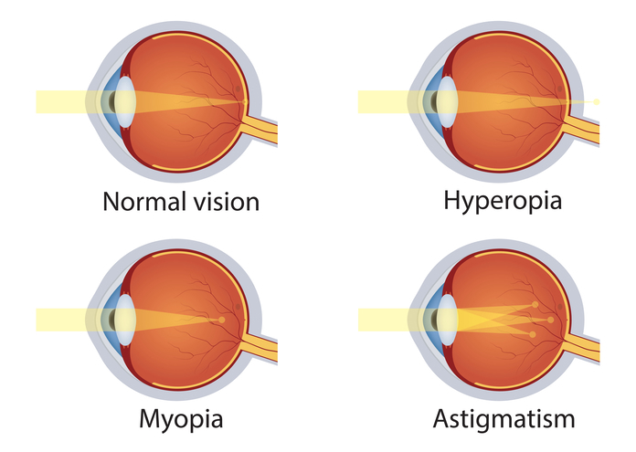 Myopia and astigmatism