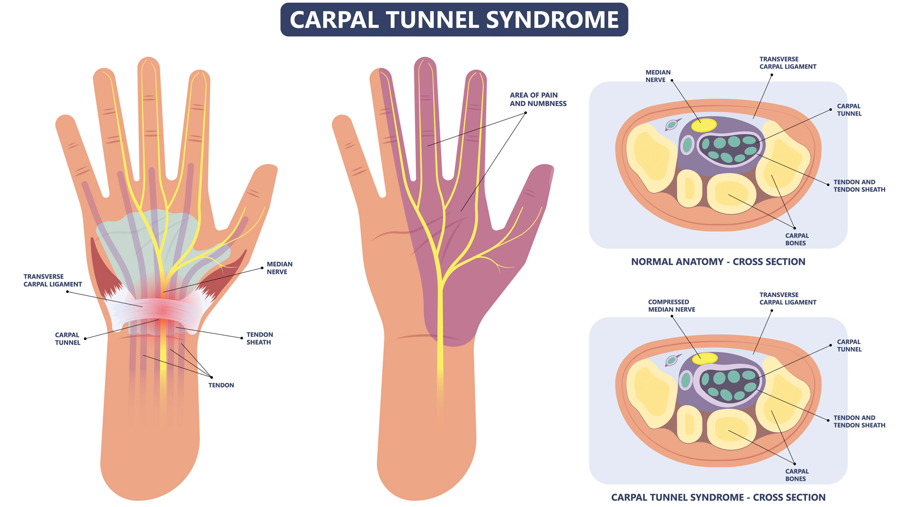 How to prevent carpal tunnel syndrome