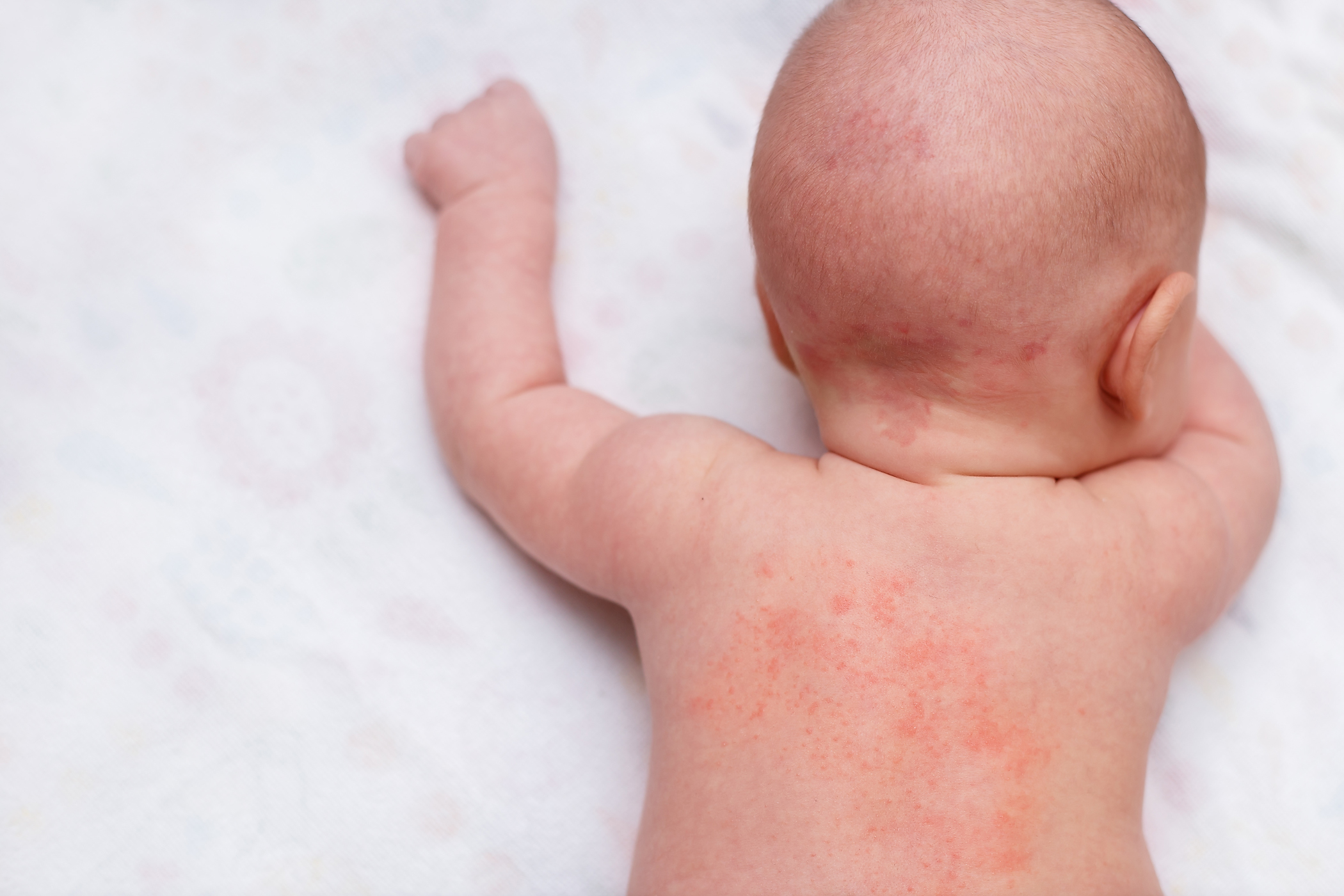 Hives in babies