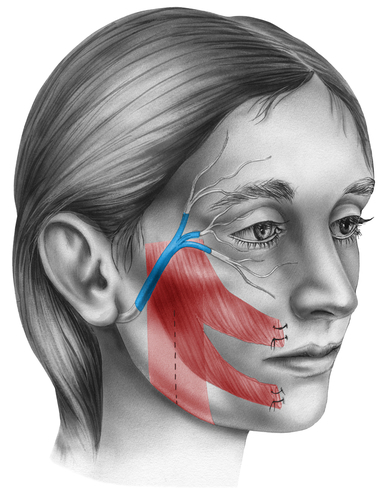 Parálisis del nervio facial