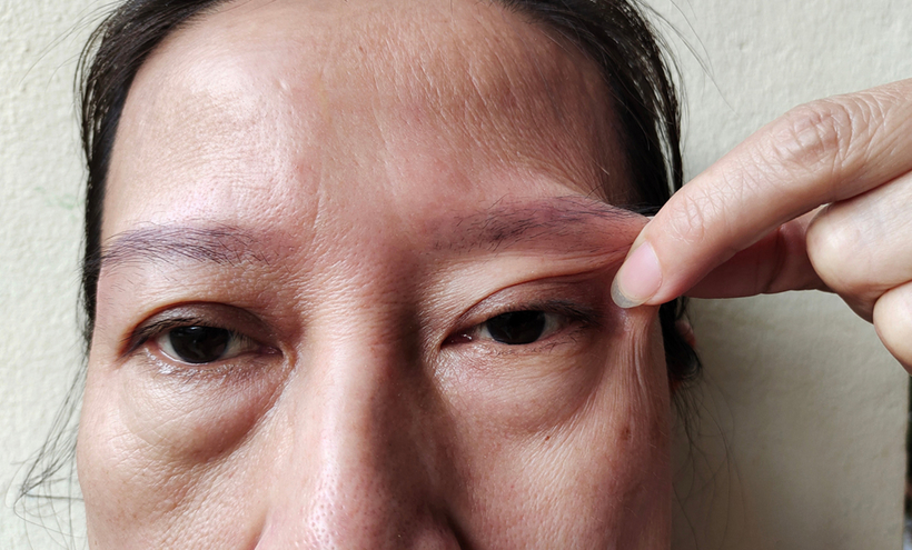 Assessment of patients with Ptosis