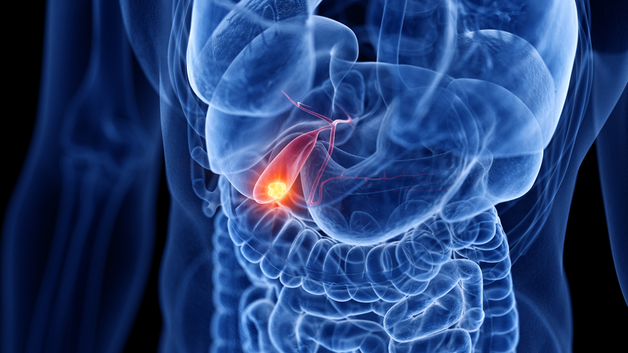 Gallbladder cancer causes