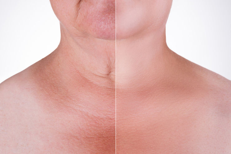 Types of Neck Lifts