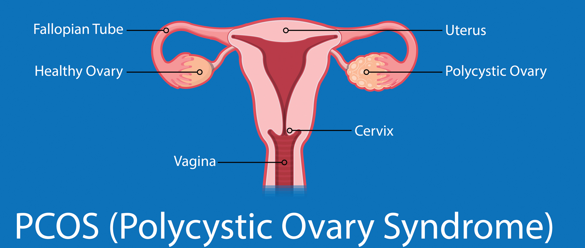 cyst on ovary PCOS