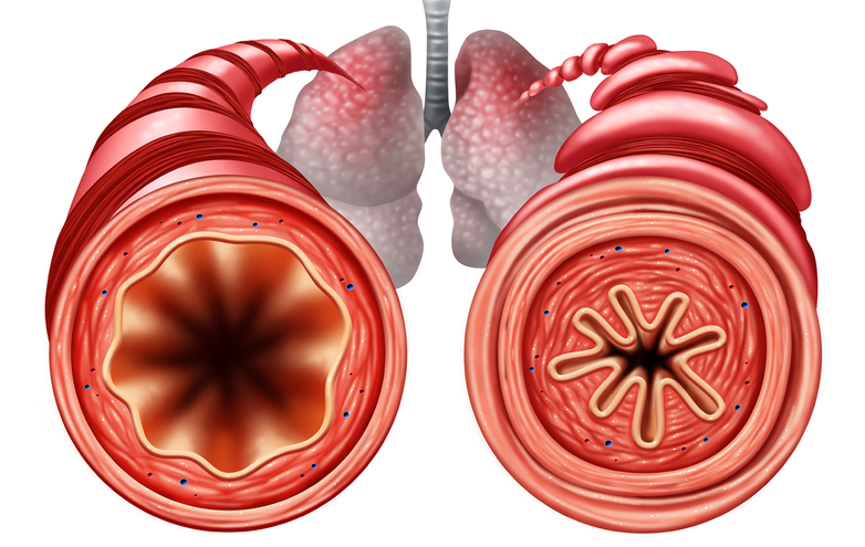 Pathophysiology of Bronchial Asthma