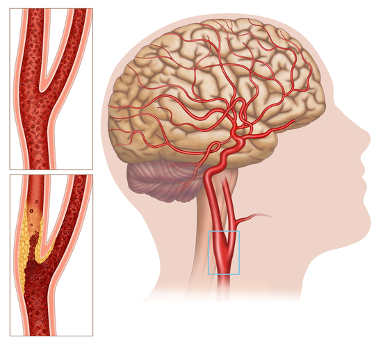 Carotid Artery Diseases