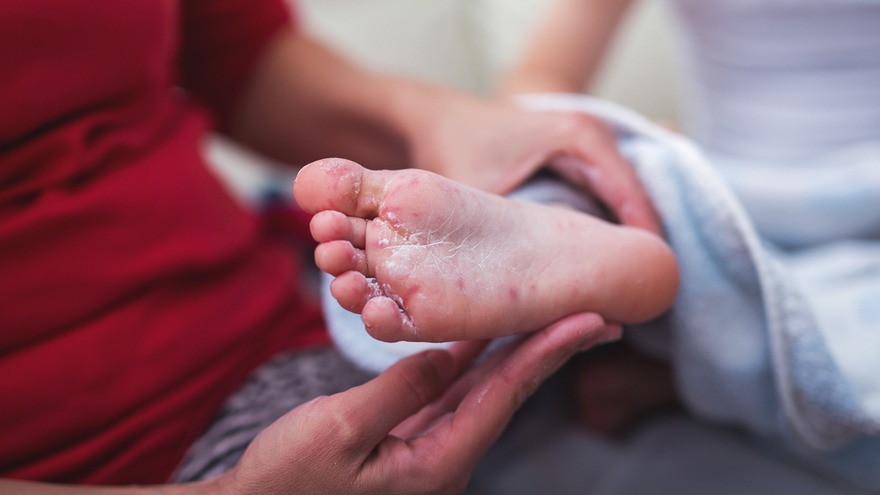 treatment for hand foot and mouth disease
