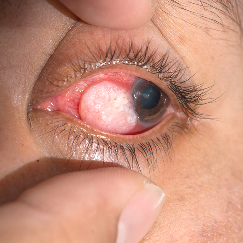 treatment for eye tumors