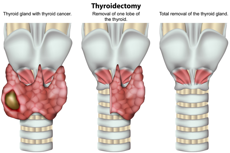 thyroidectomy