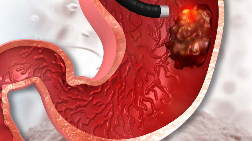 Specialties-Gastric Cancer