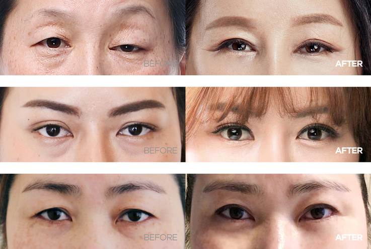 Before and After ptosis correction
