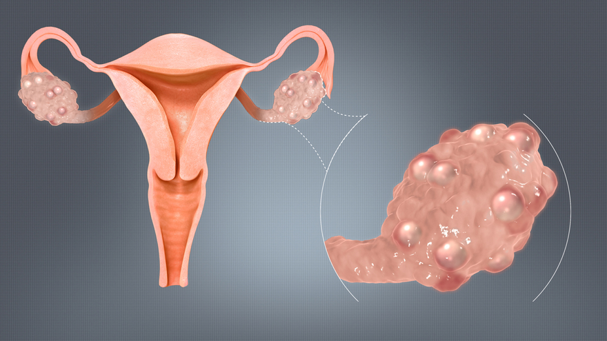 Endometrioma treatment