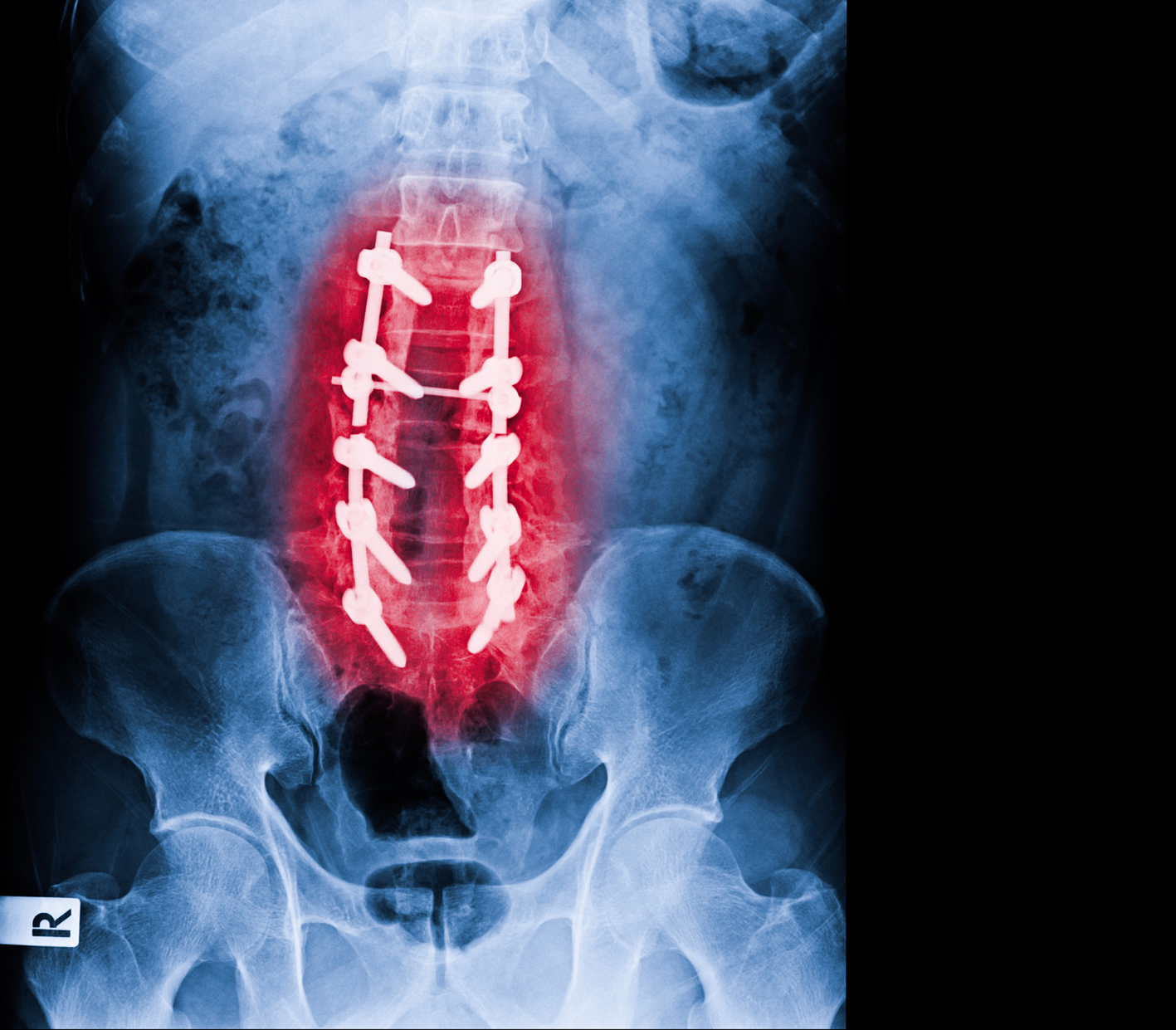 Anterior Lumbar Interbody Fusion (ALIF)