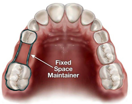 6-Removable-orthodontic-appliance-a4ffd233-3f7a-4e4b-b6ea-80583e4ab0dd.jpg